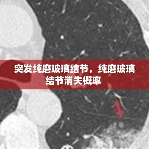 突发纯磨玻璃结节，纯磨玻璃结节消失概率 