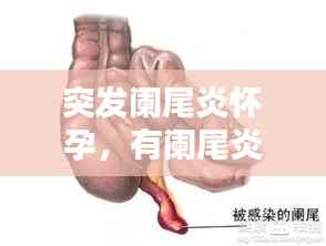 突发阑尾炎怀孕，有阑尾炎怀孕了之后会疼 